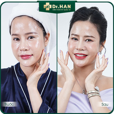 Khách hàng Hoài An hồi xuân với chăm sóc & trẻ hóa da tại Dr. HAN