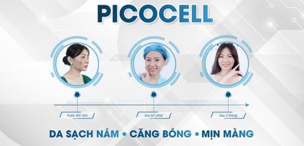 công nghệ trị nám pico cell là gì