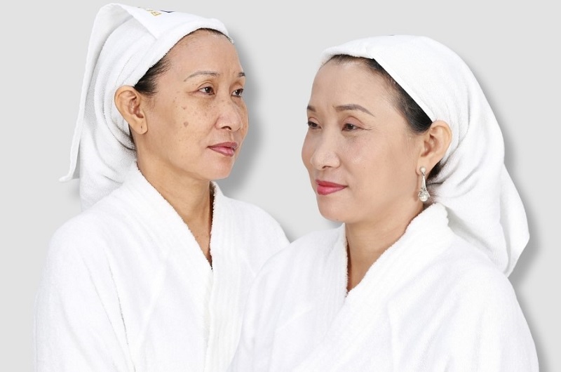 điều trị tàn nhang tại spa, trị tàn nhang tại spa, trị tàn nhang ở đâu tốt nhất